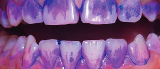 Dentes com o revelador de biofilme aplicado, mostrando as áreas afetadas