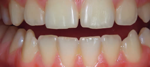 Dentes antes da aplicação do revelador de biofilme