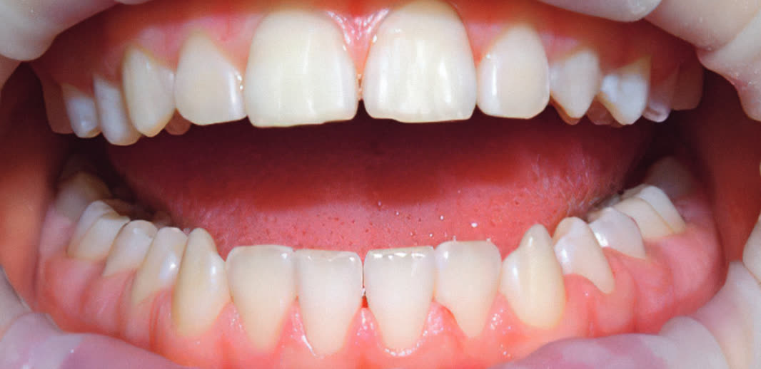 Resultado de uma limpeza dental com Airflow na Clínica Lanfredi